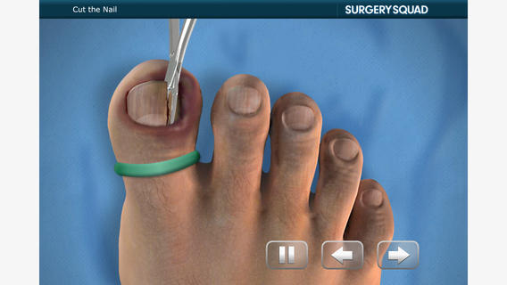 ingrown toenail removal